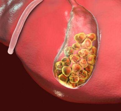 Safra-Kesesi-Ameliyati