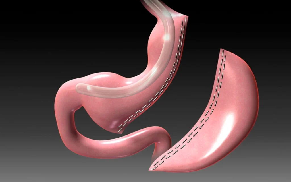 tup-mide-ameliyati-cikarilan-mide-03